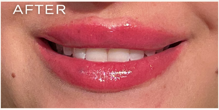 Vorher-Nachher-Vergleich einer Lippen-behandlung