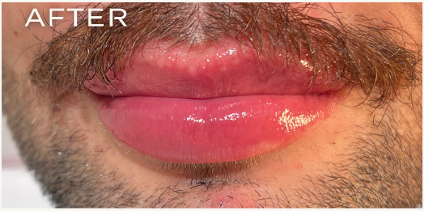 Vorher-Nachher-Vergleich einer Lippen-Behandlung bei Mann