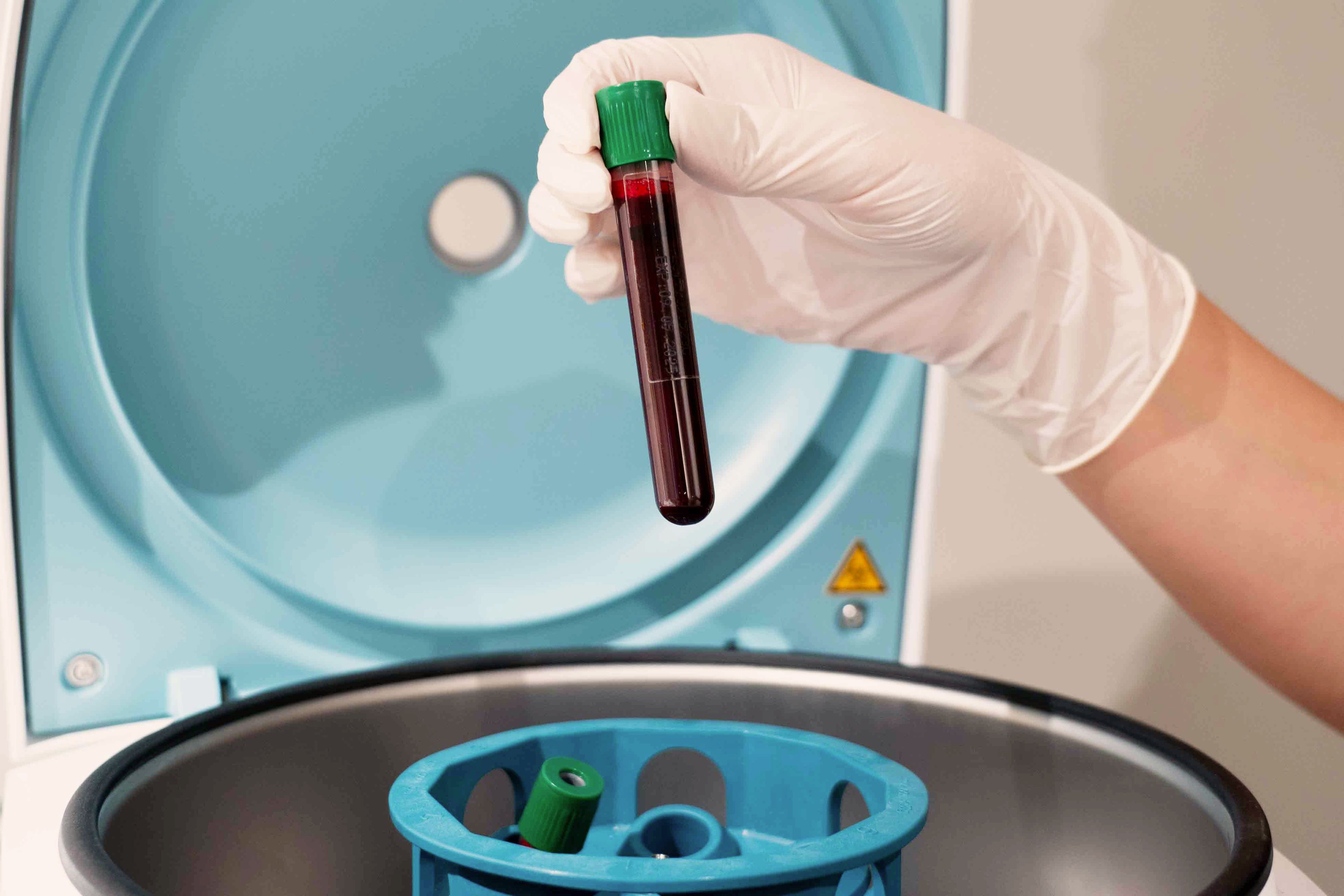 Blutprobe für PRP-Therapie (Platelet-Rich Plasma) bei MYH&B